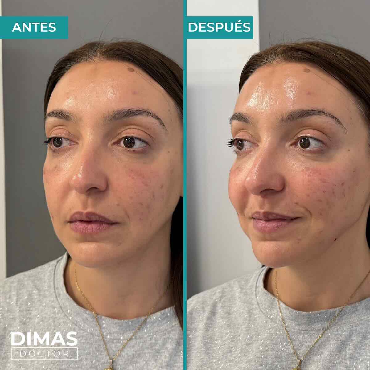 Armonización facial en rostro de mujer en Barcelona