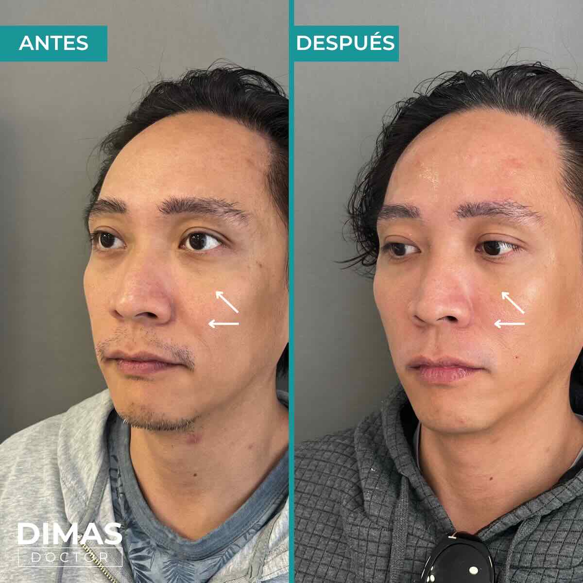 Armonización facial en rostro de hombre en Barcelona