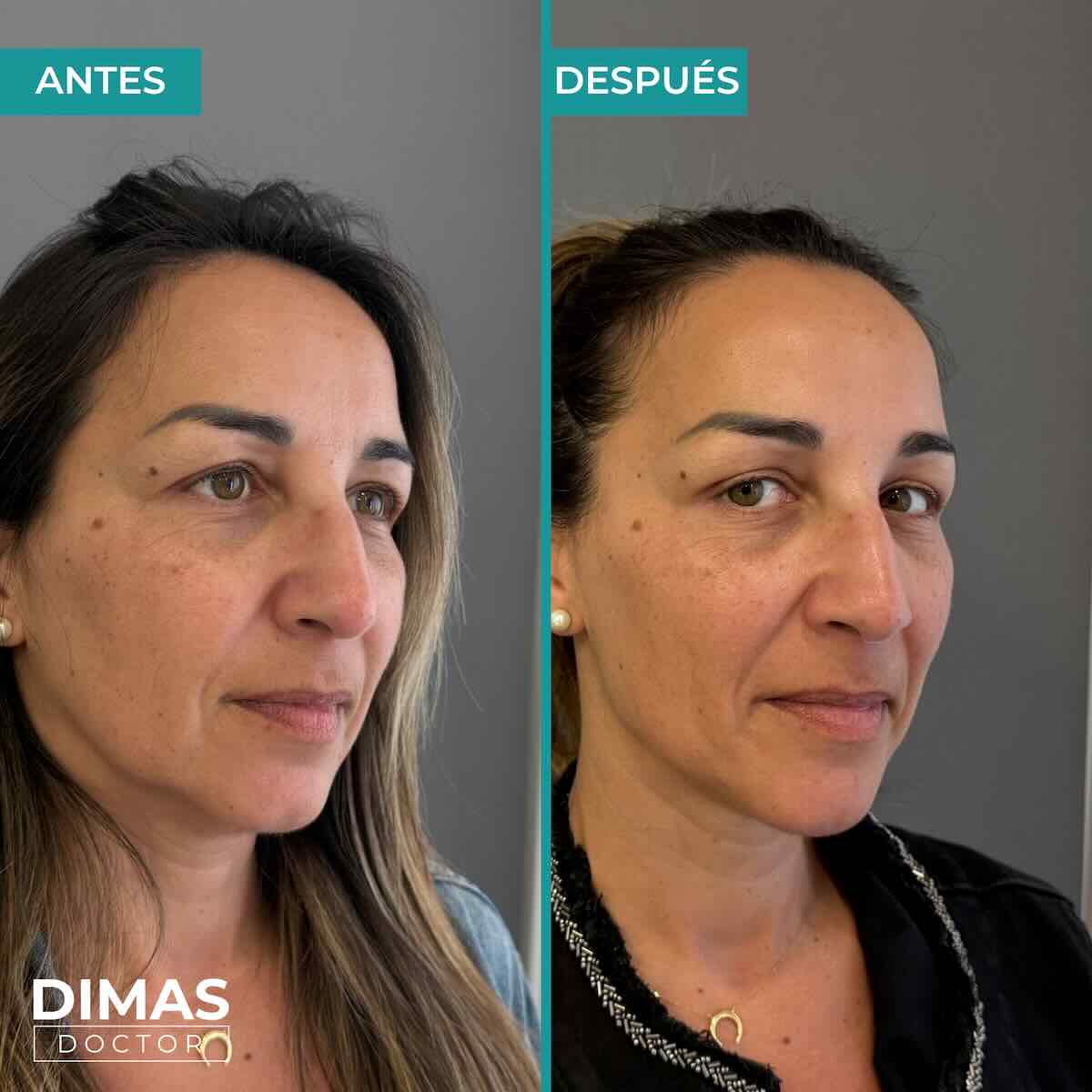Armonización facial en rostro de mujer en Barcelona