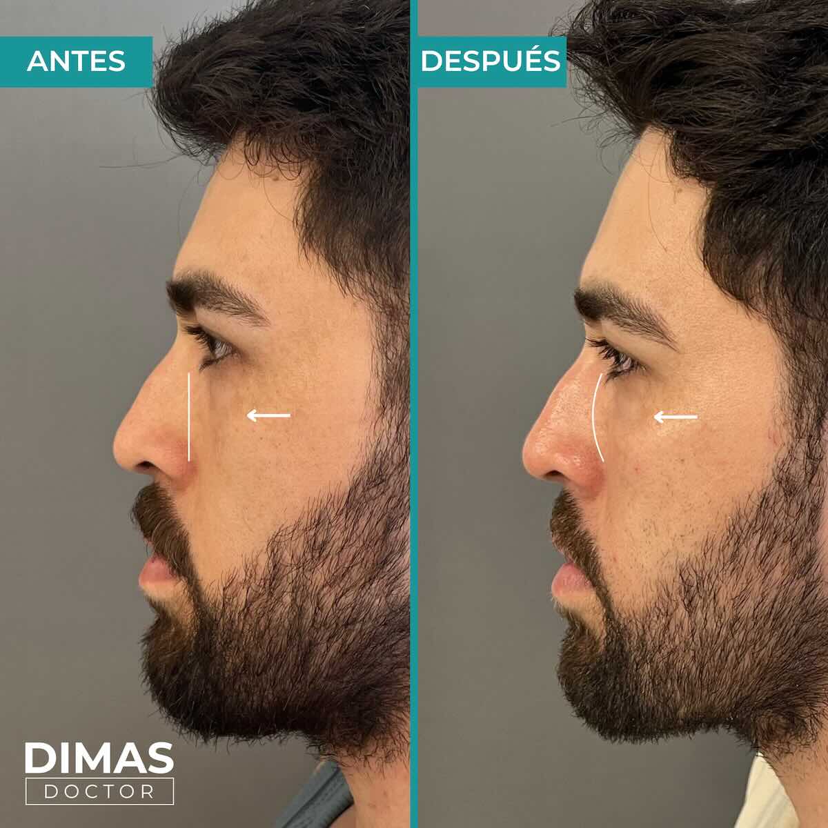 Armonización facial en rostro de hombre en Barcelona