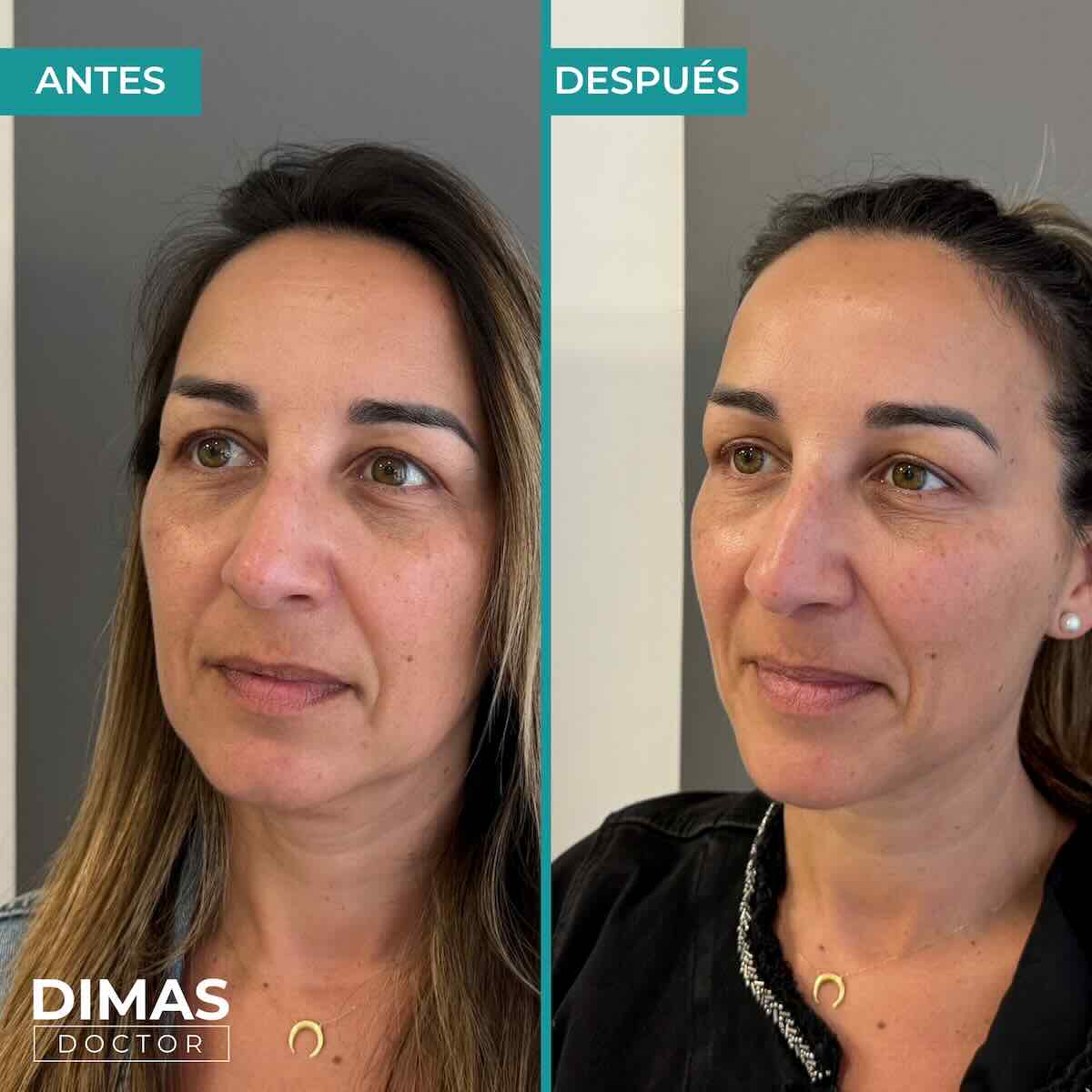 Armonización facial en rostro de mujer en Barcelona