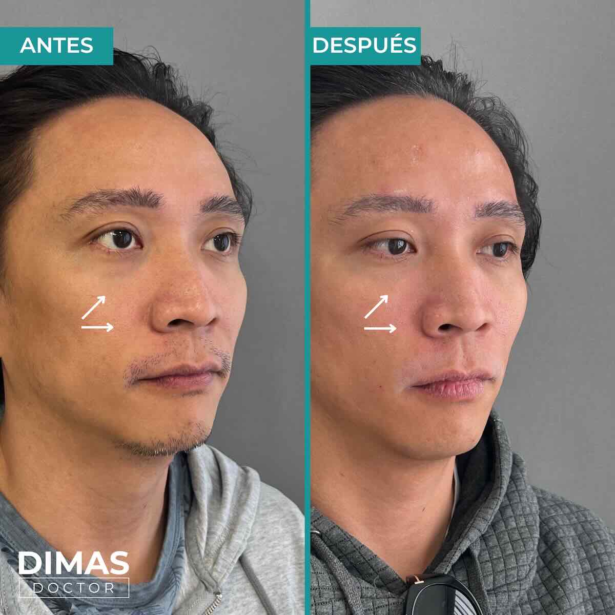 Armonización facial en rostro de hombre en Barcelona