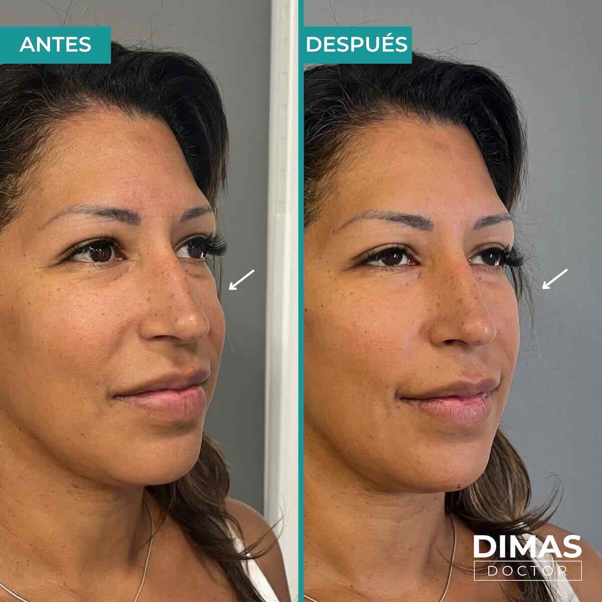 Armonización facial en rostro de mujer en Barcelona