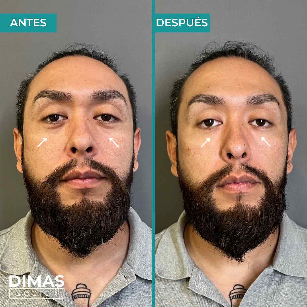 Armonización facial en rostro de hombre en Barcelona