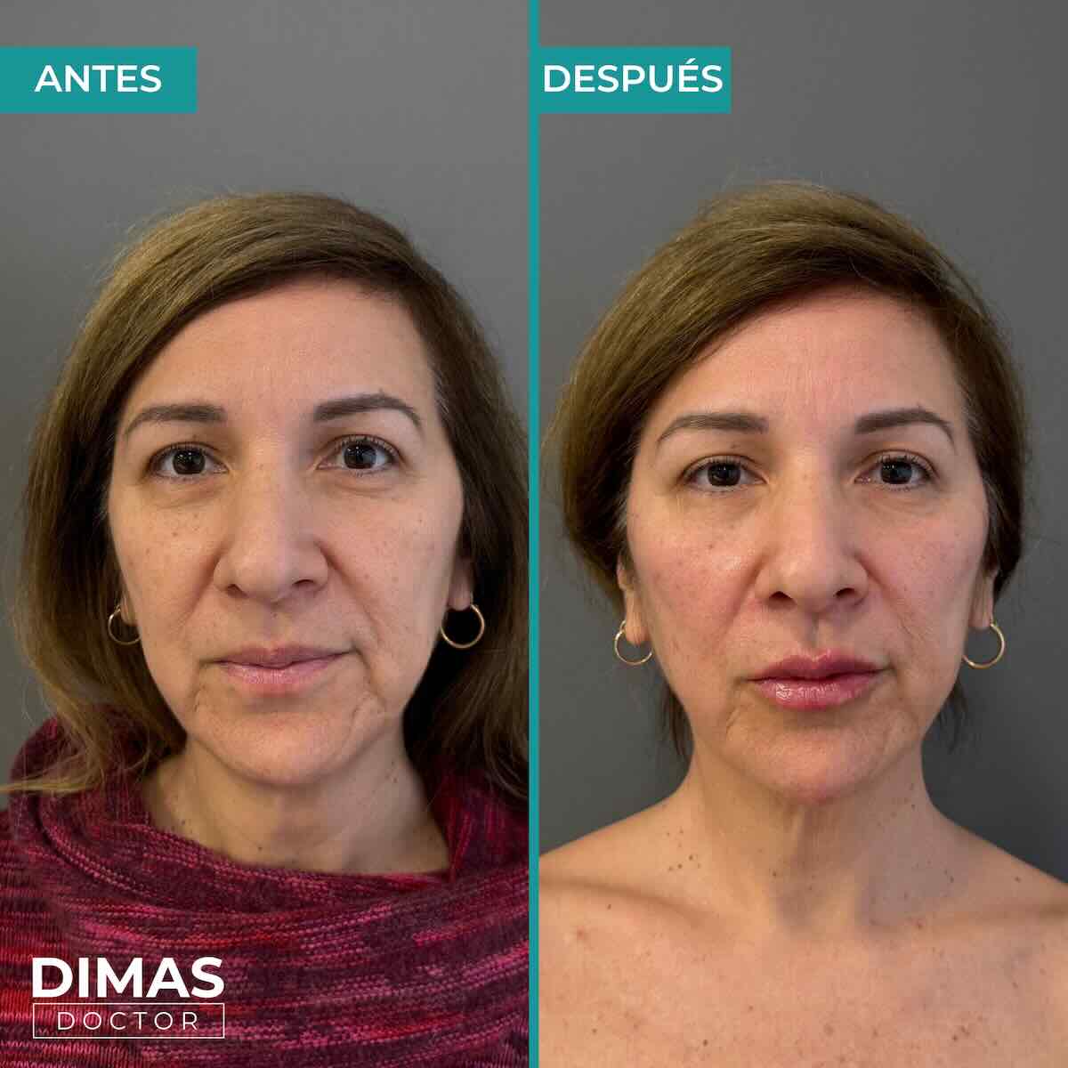 Armonización facial en rostro de mujer en Barcelona