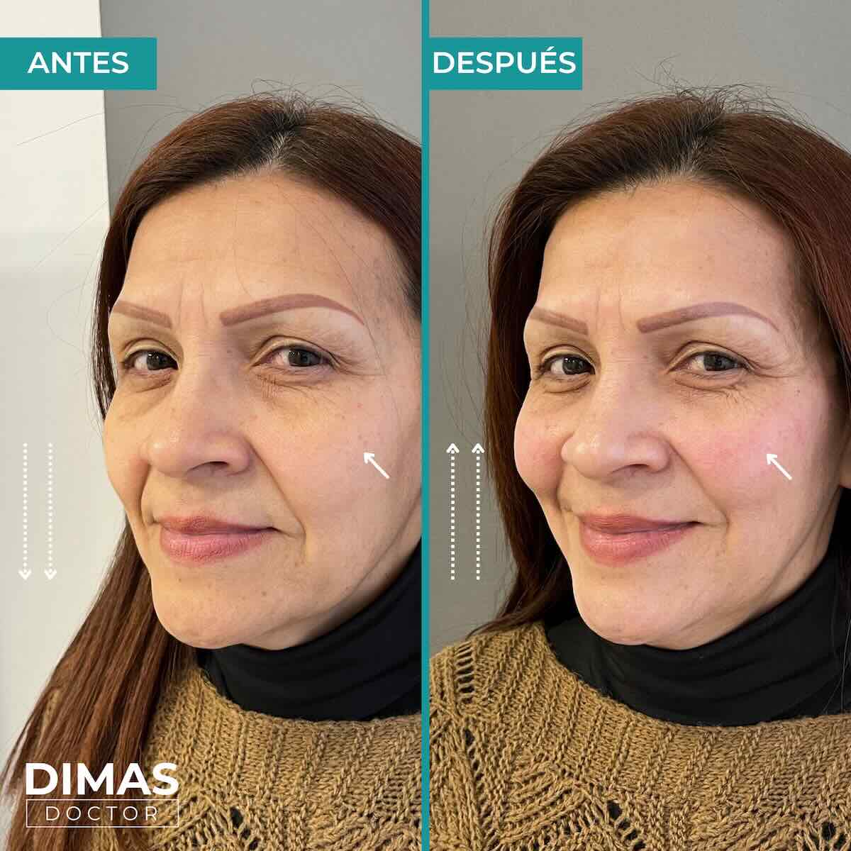 Armonización facial en rostro de mujer en Barcelona