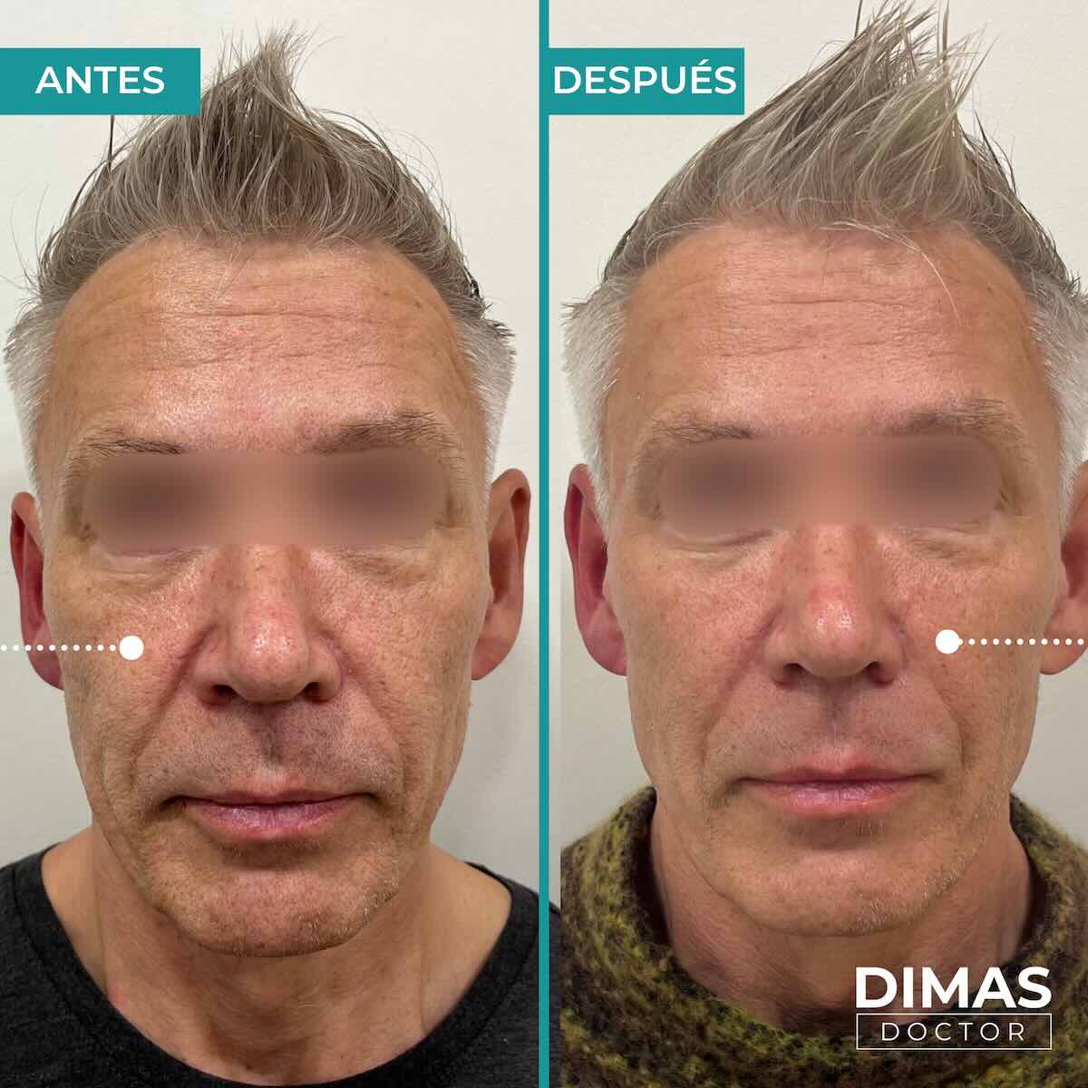 Armonización facial en rostro de hombre en Barcelona