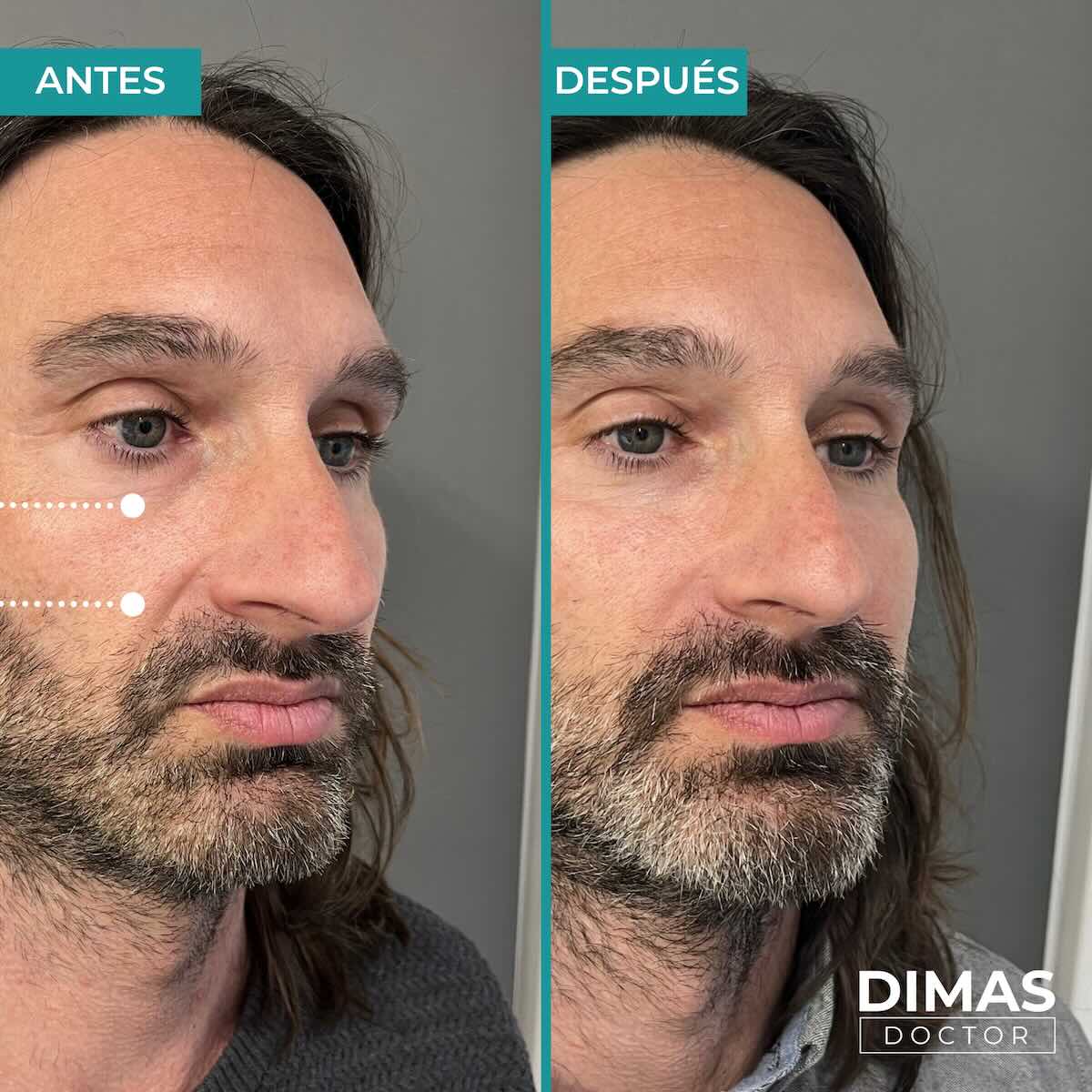 Armonización facial en rostro de hombre en Barcelona