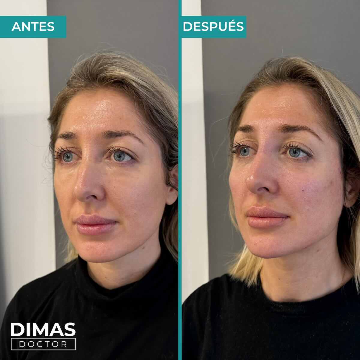 Armonización facial en rostro de mujer en Barcelona