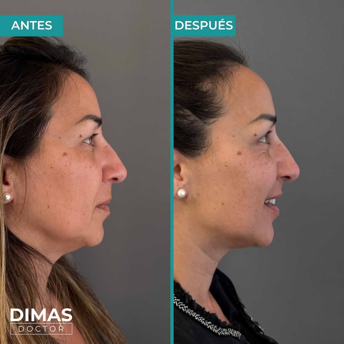 Armonización facial en rostro de mujer en Barcelona