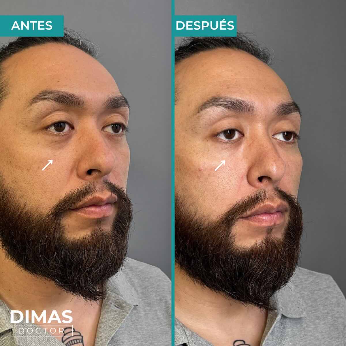 Armonización facial en rostro de hombre en Barcelona
