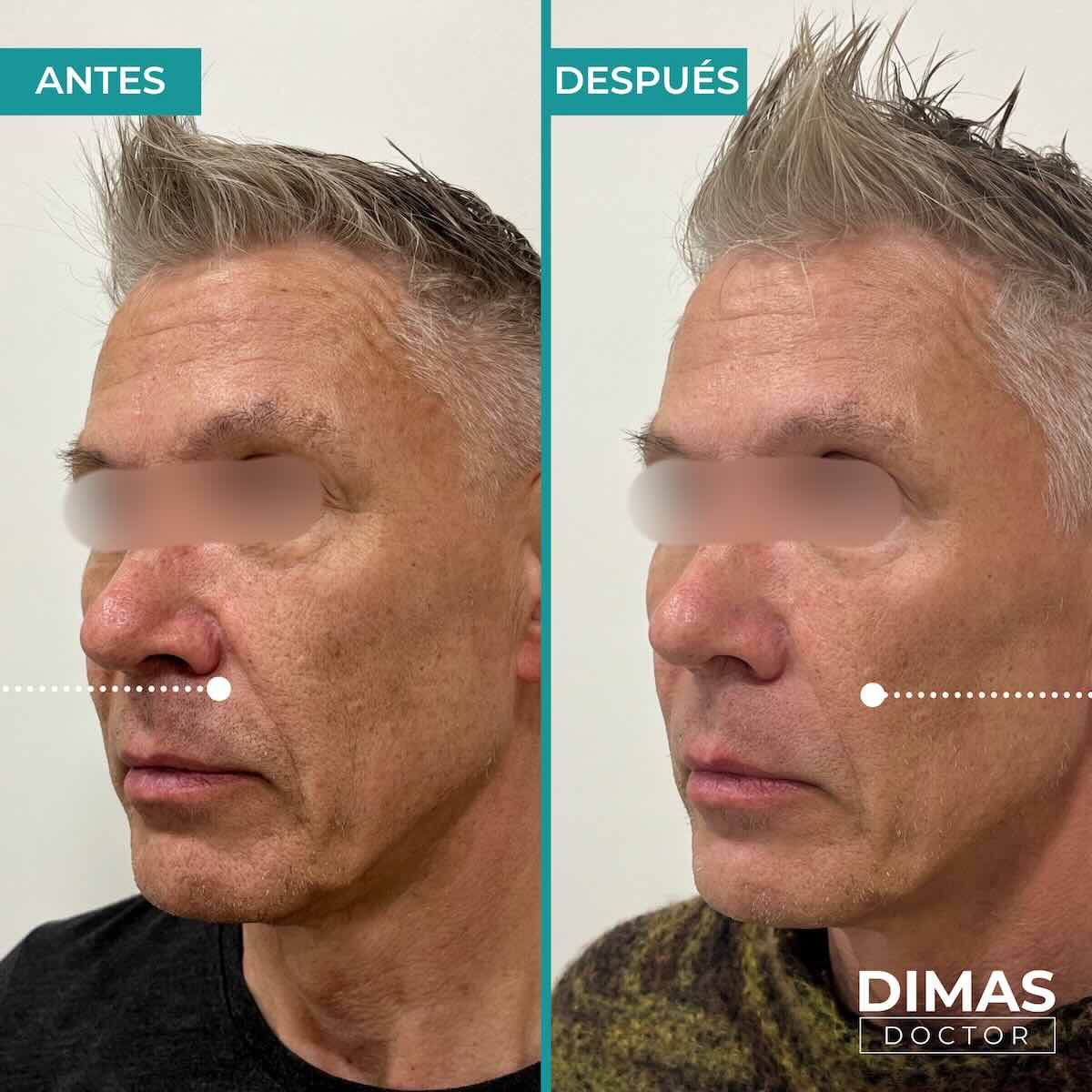 Armonización facial en rostro de hombre en Barcelona