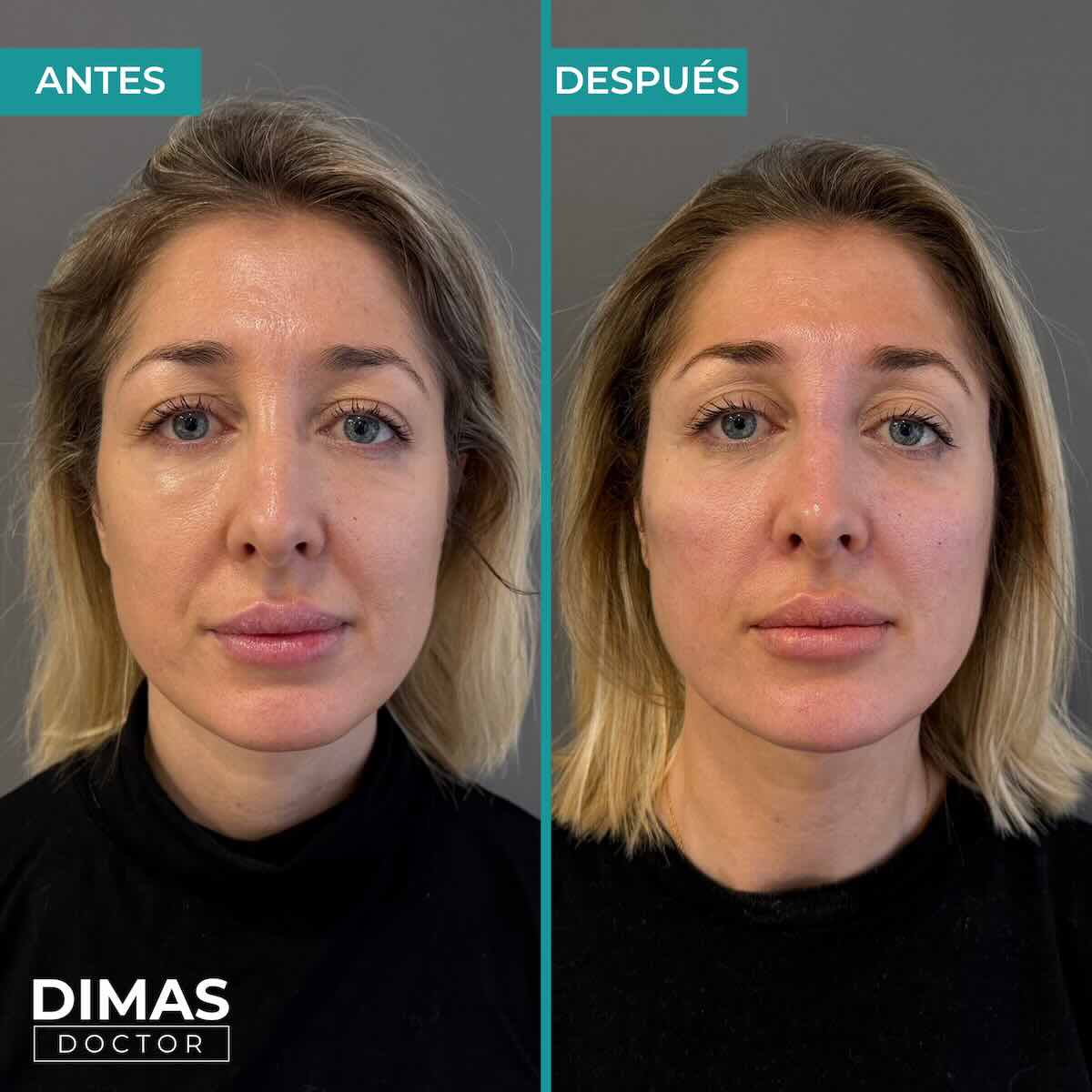 Armonización facial en rostro de mujer en Barcelona