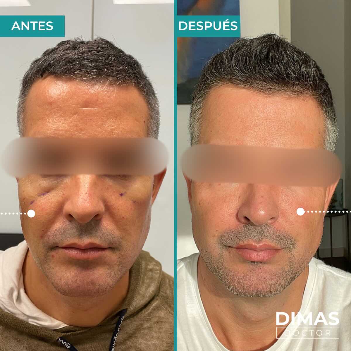 Armonización facial en rostro de hombre en Barcelona