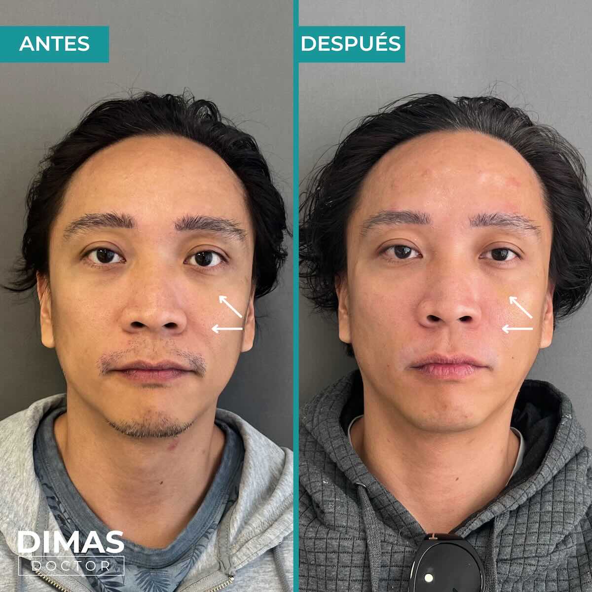 Armonización facial en rostro de hombre en Barcelona