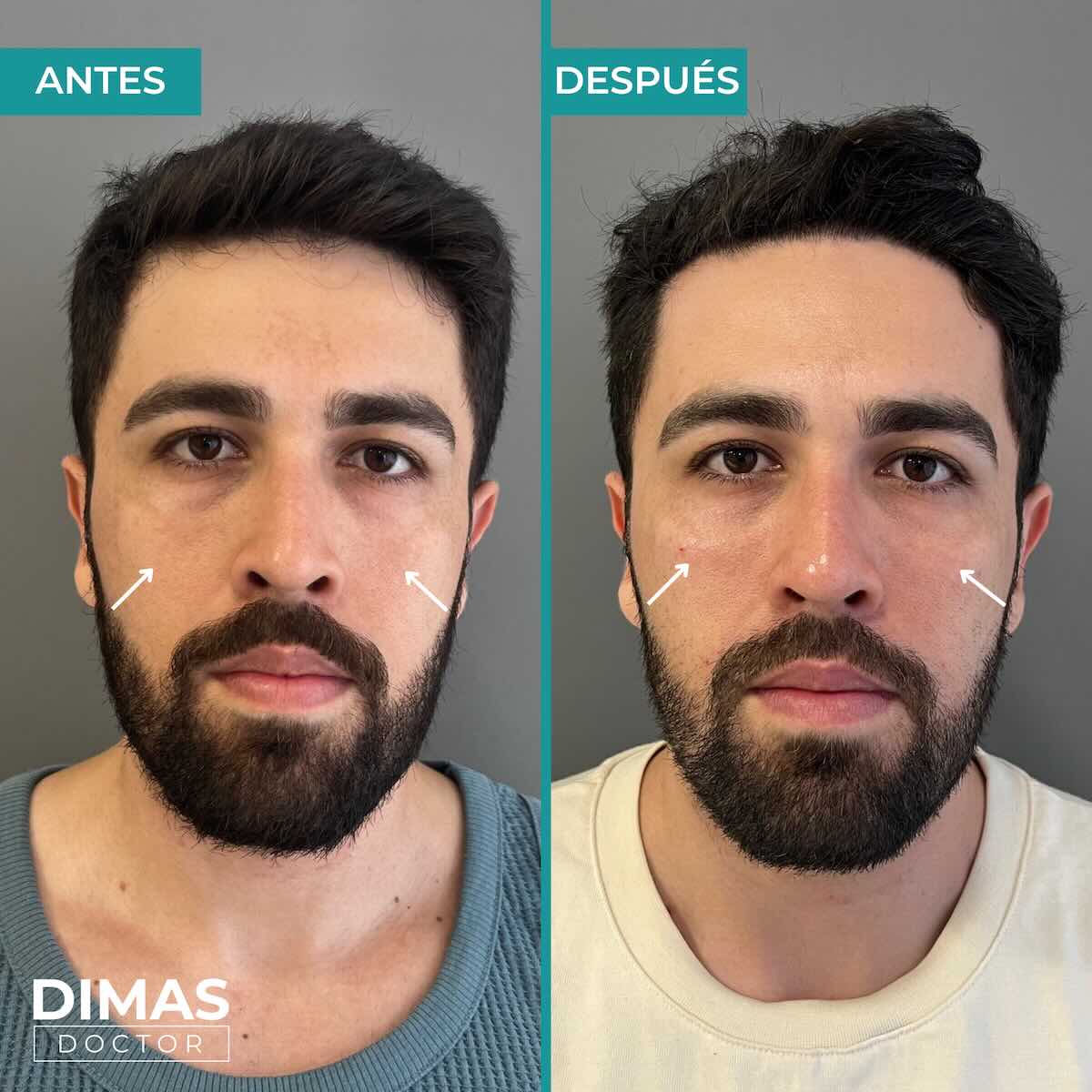 Armonización facial en rostro de hombre en Barcelona