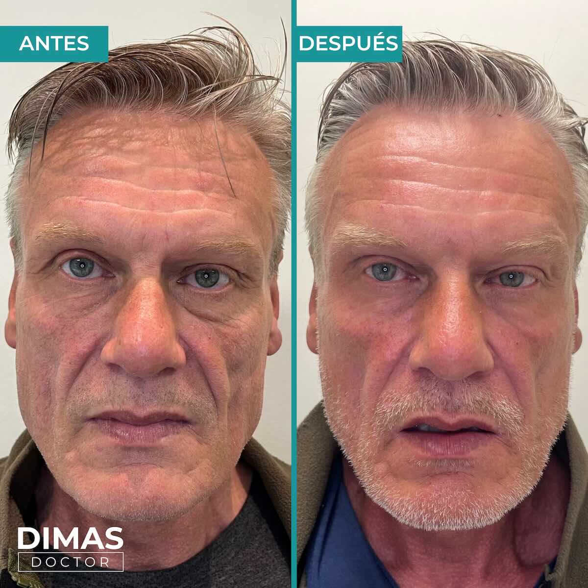 Armonización facial en rostro de hombre en Barcelona