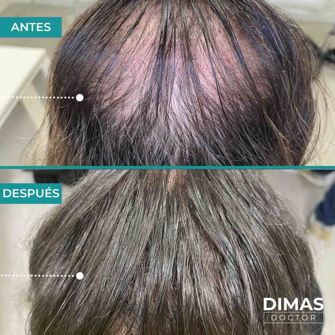 Antes y después del tratamiento de alopecia en Barcelona