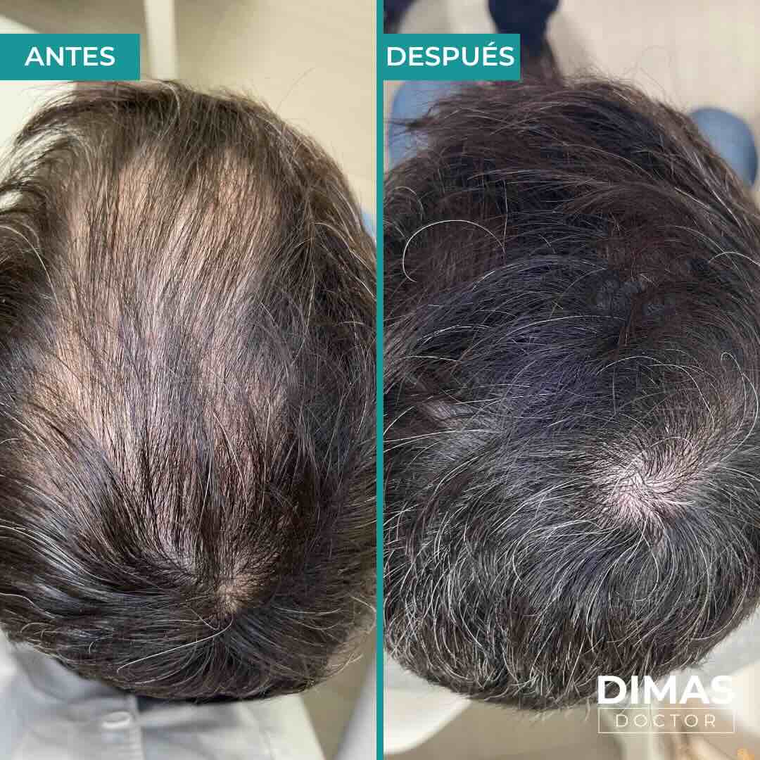 Antes y después del tratamiento de alopecia en Barcelona