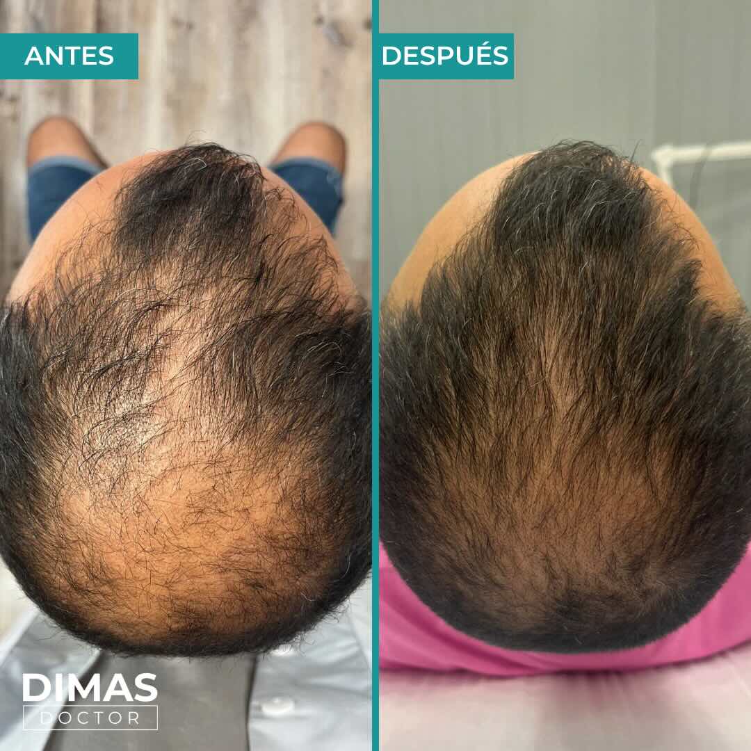 Antes y después del tratamiento de alopecia en Barcelona