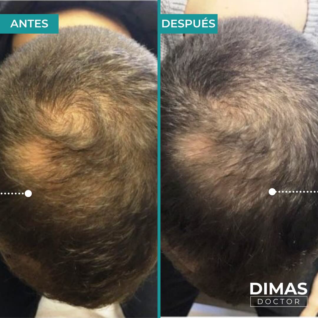 Antes y después del tratamiento de alopecia en Barcelona