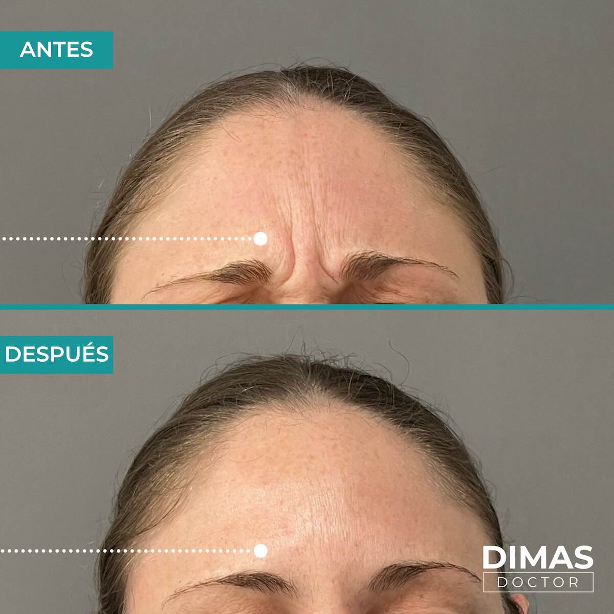 Resultados en entrecejo tras tratamiento con toxina botulínica bótox