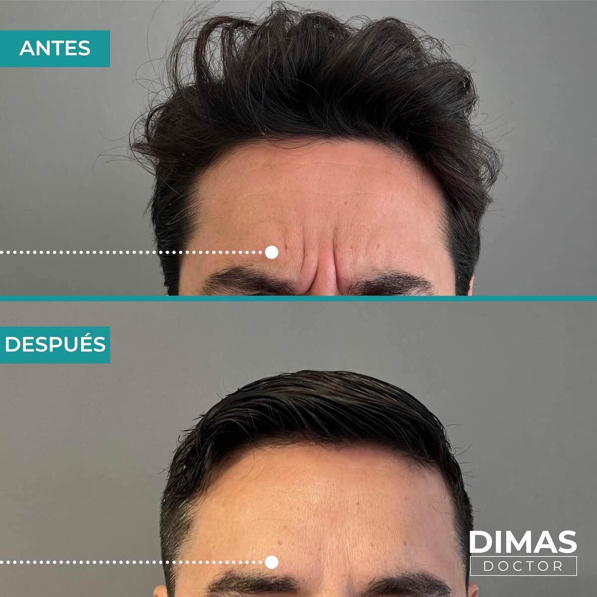 Resultados en entrecejo tras tratamiento con toxina botulínica bótox