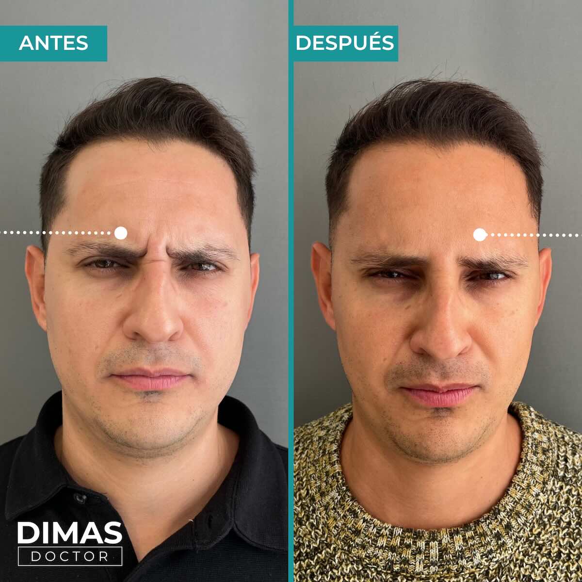 Resultados en entrecejo tras tratamiento con toxina botulínica bótox