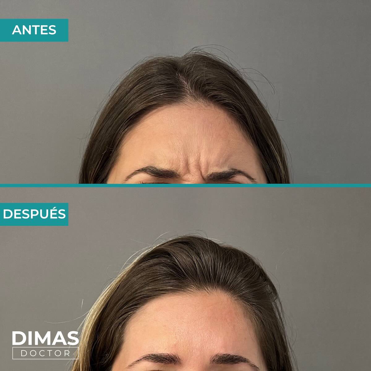 Resultados en la frente tras tratamiento con toxina botulínica bótox