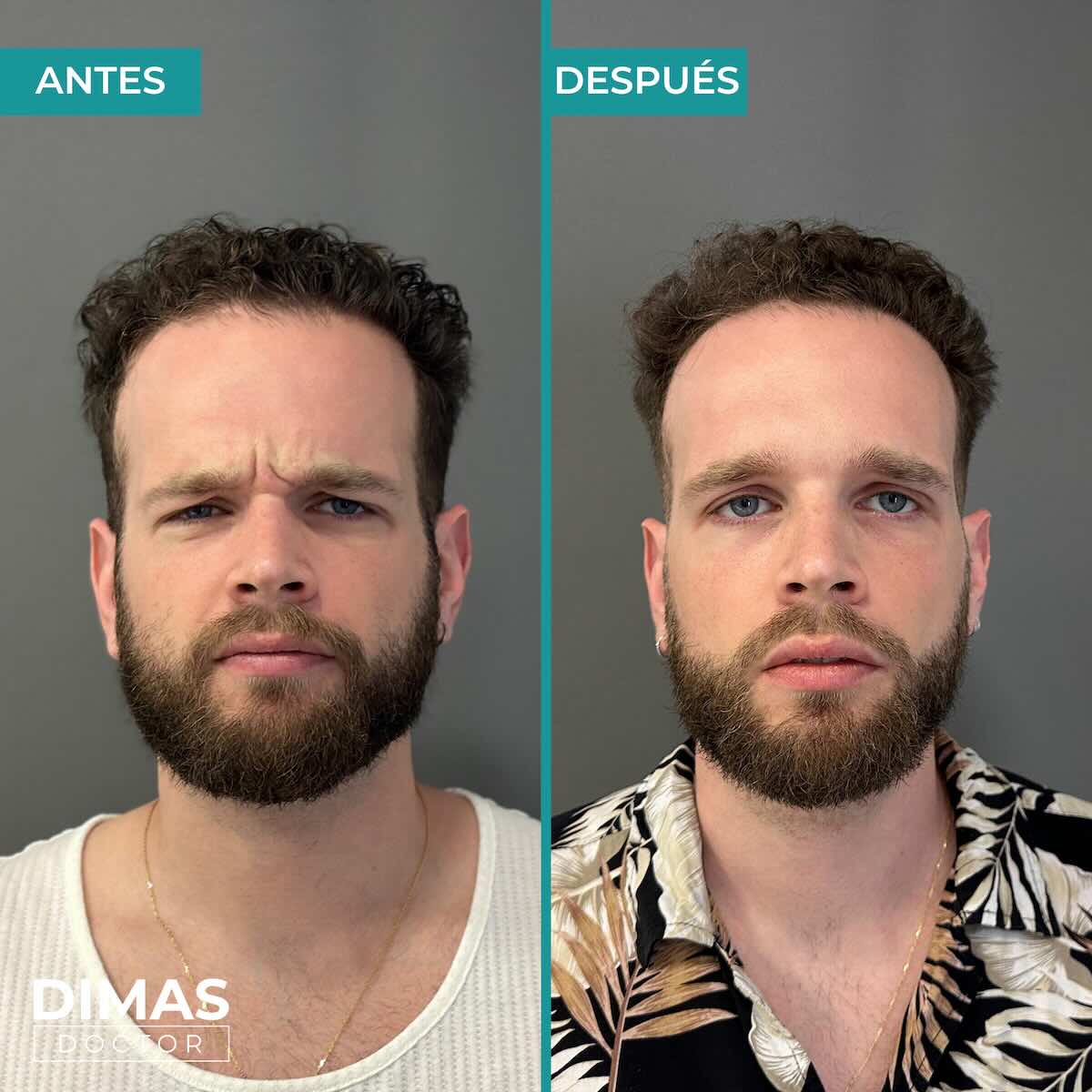 Resultados en entrecejo tras tratamiento con toxina botulínica bótox