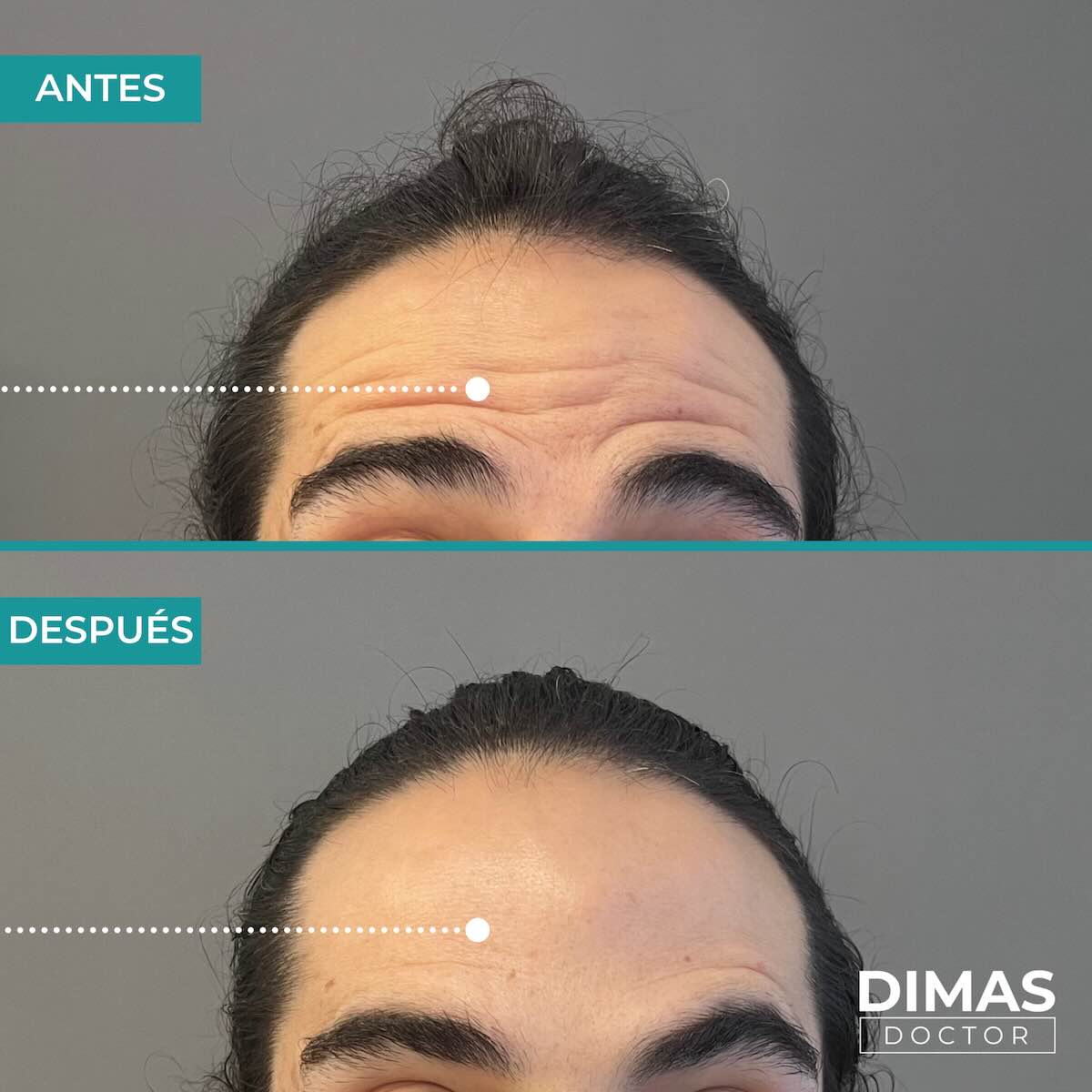 Resultados en la frente tras tratamiento con toxina botulínica bótox