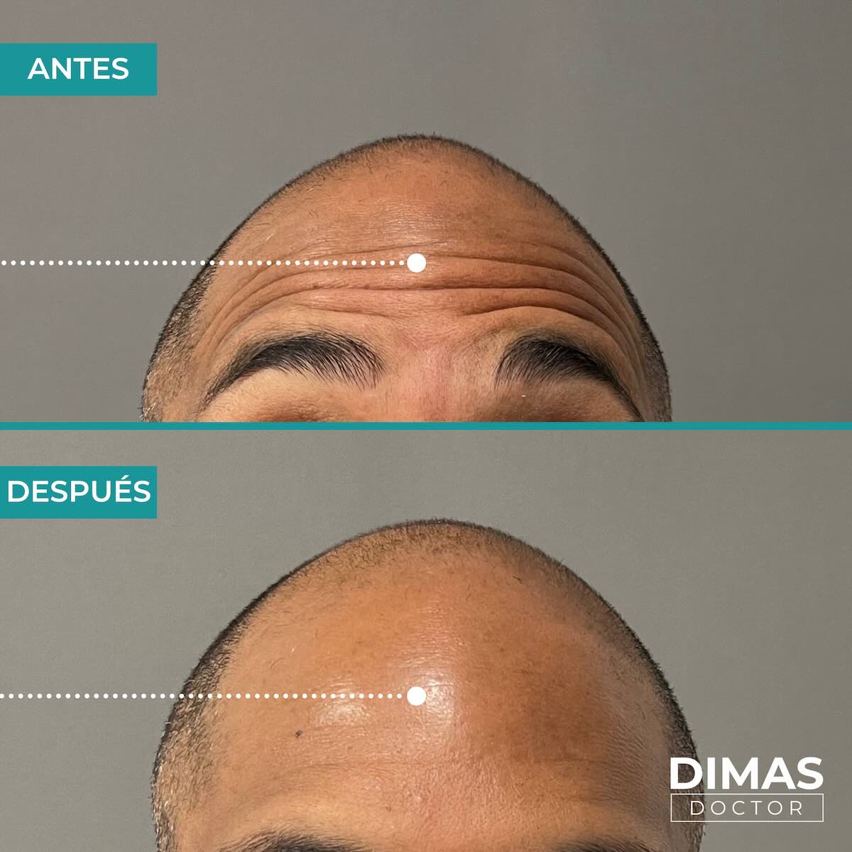 Resultados en la frente tras tratamiento con toxina botulínica bótox