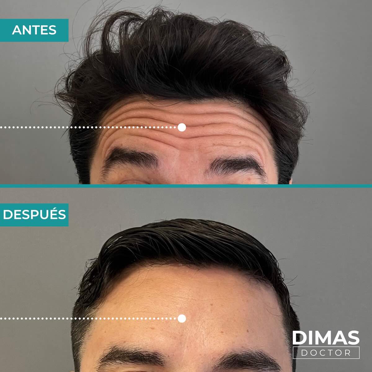 Resultados en la frente tras tratamiento con toxina botulínica bótox