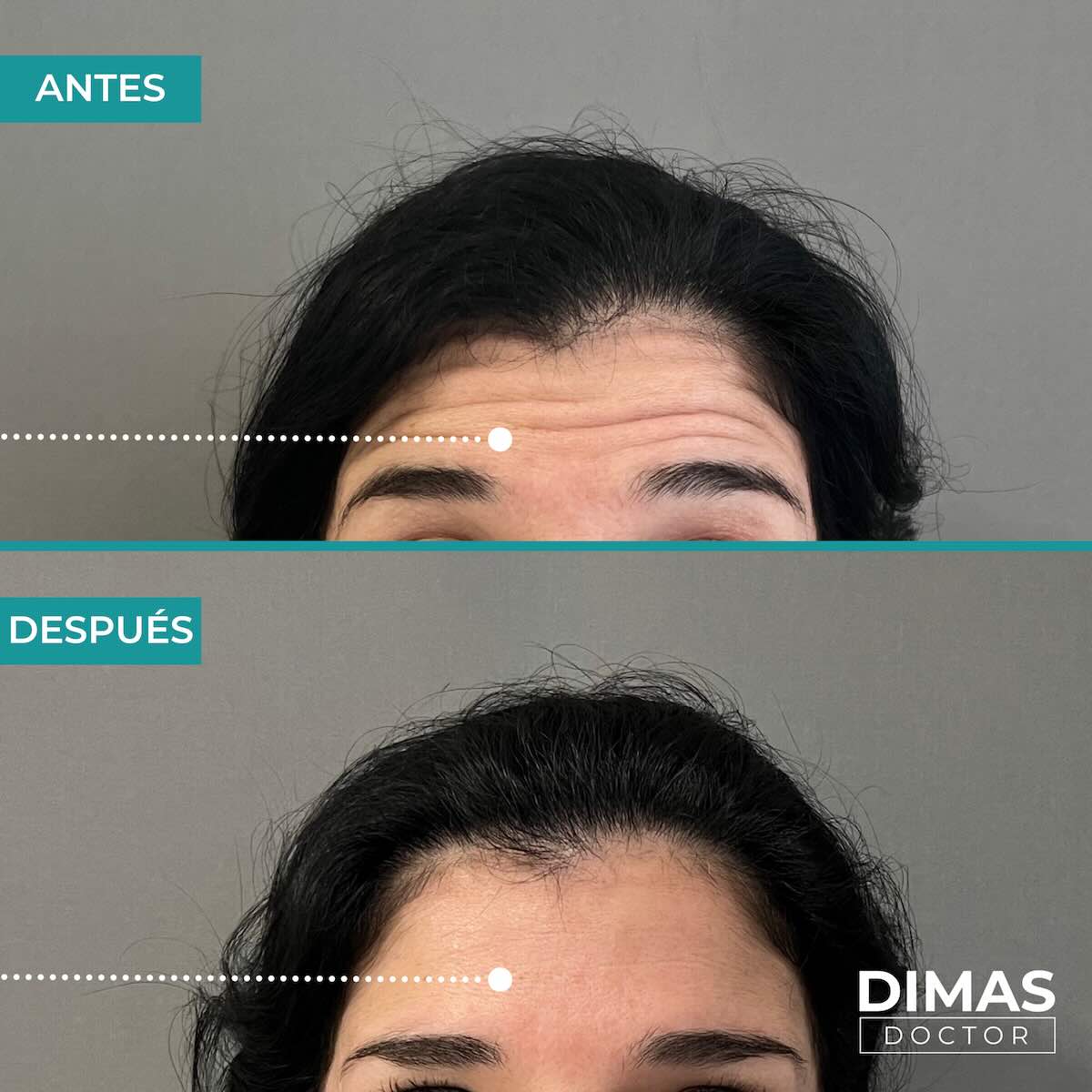 Resultados en la frente tras tratamiento con toxina botulínica bótox