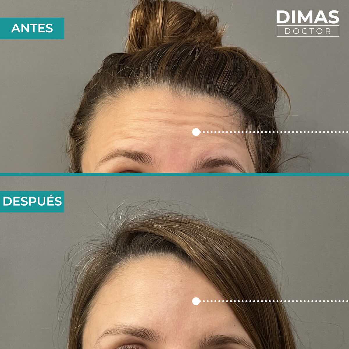 Resultados en la frente tras tratamiento con toxina botulínica bótox