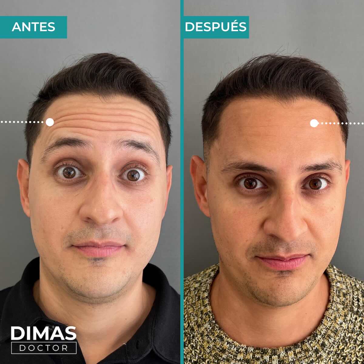 Resultados en la frente tras tratamiento con toxina botulínica bótox