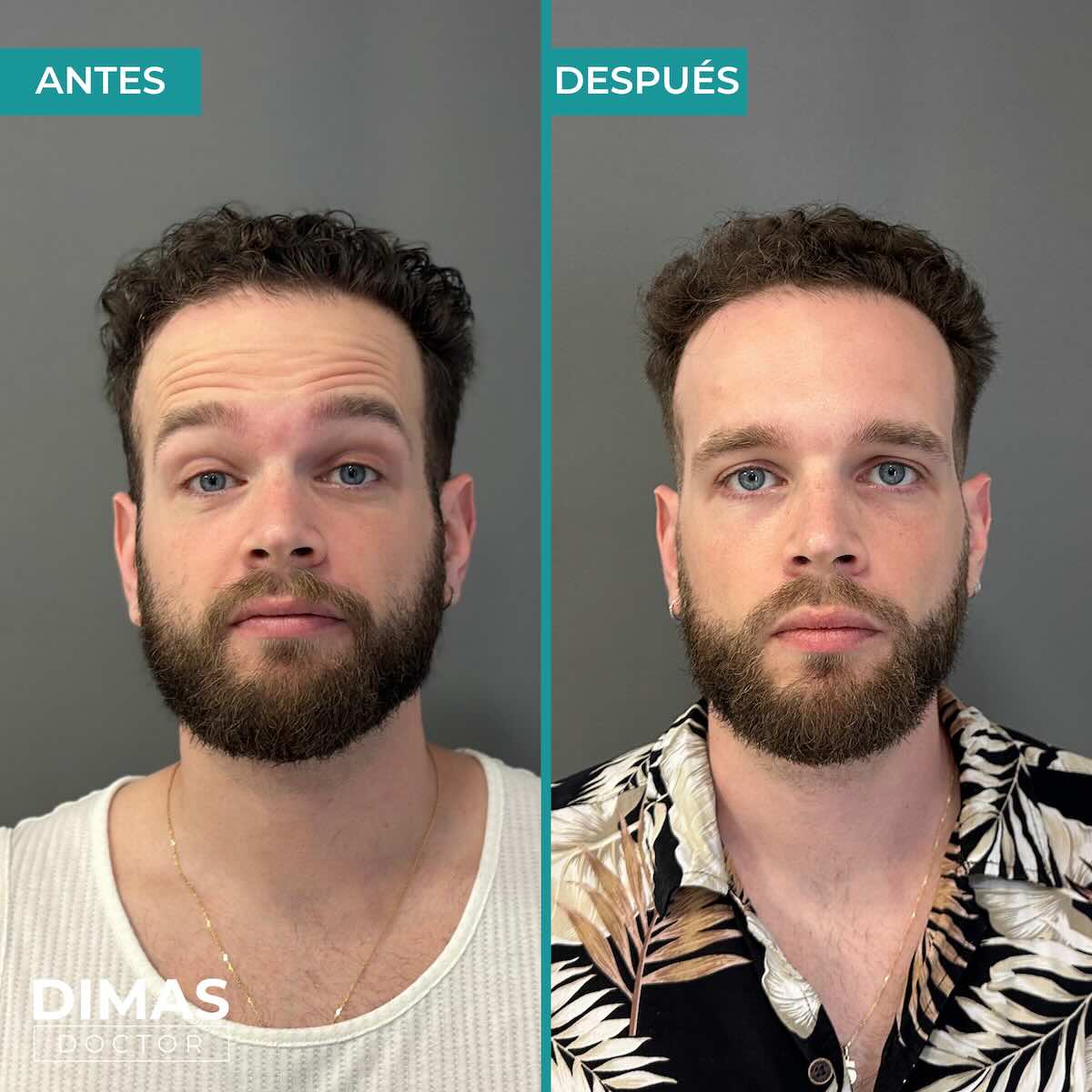 Resultados en la frente tras tratamiento con toxina botulínica bótox