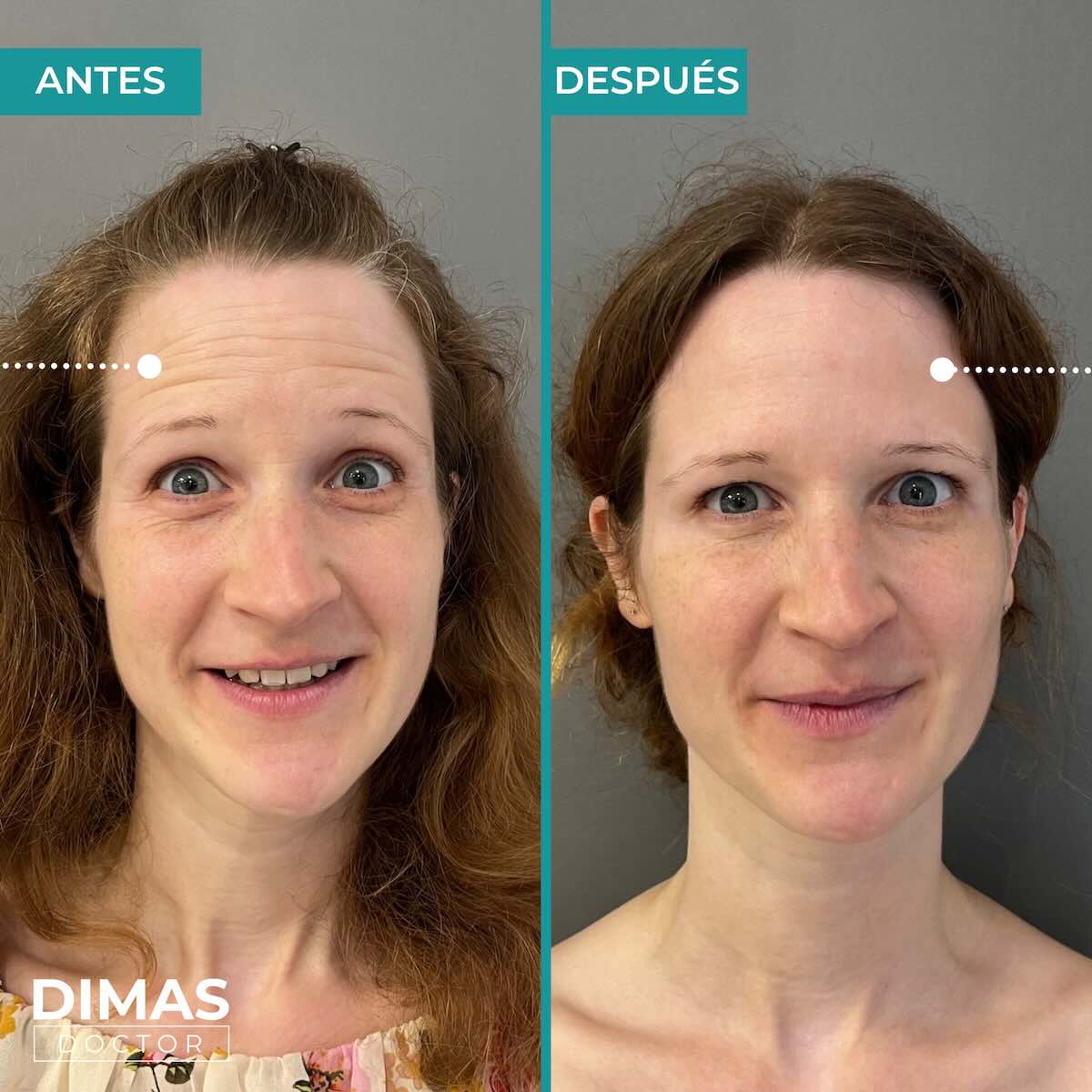 Resultados en la frente tras tratamiento con toxina botulínica bótox
