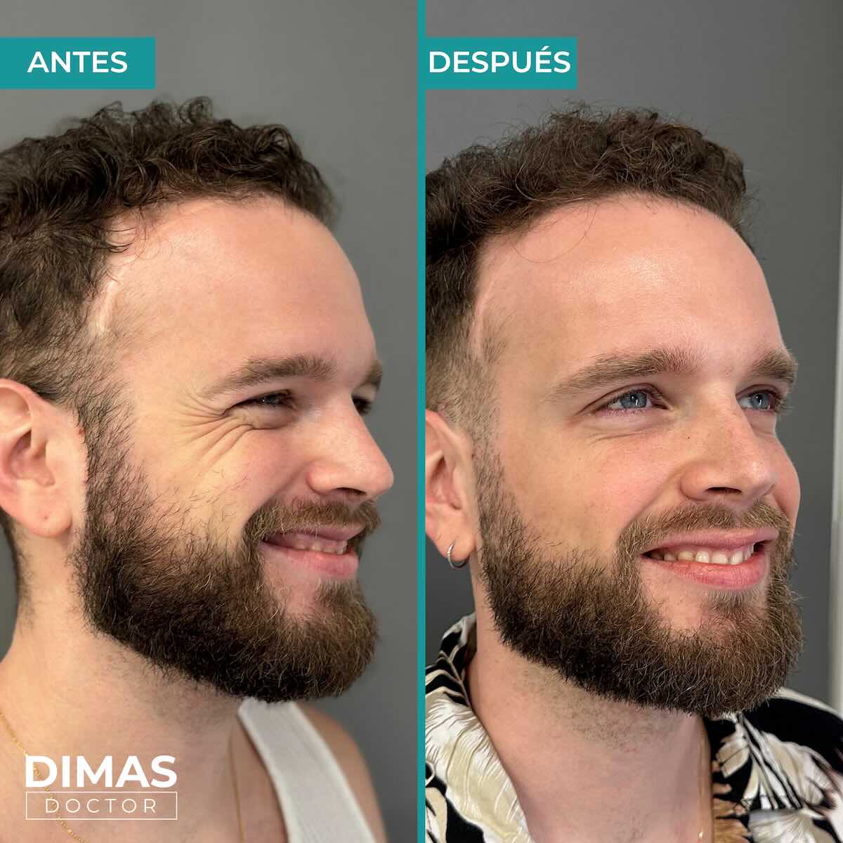 Resultados en patas de gallo tras tratamiento con toxina botulínica bótox