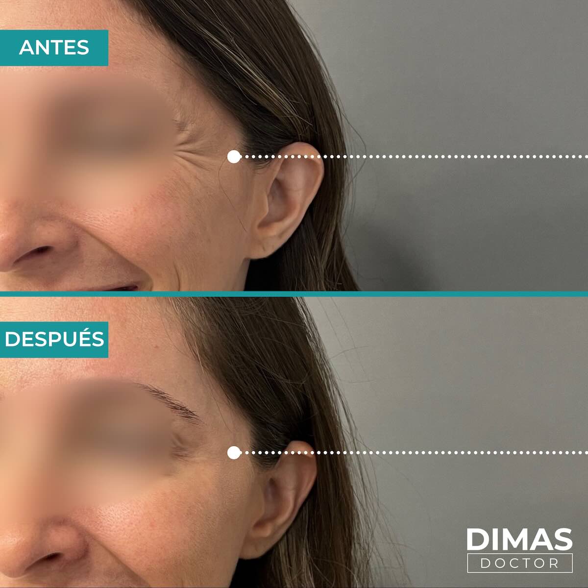 Resultados en patas de gallo tras tratamiento con toxina botulínica bótox