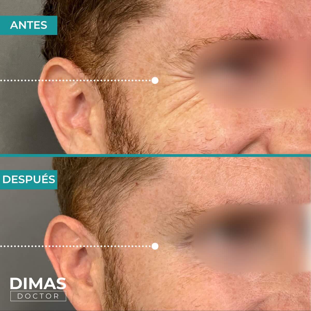 Resultados en patas de gallo tras tratamiento con toxina botulínica bótox