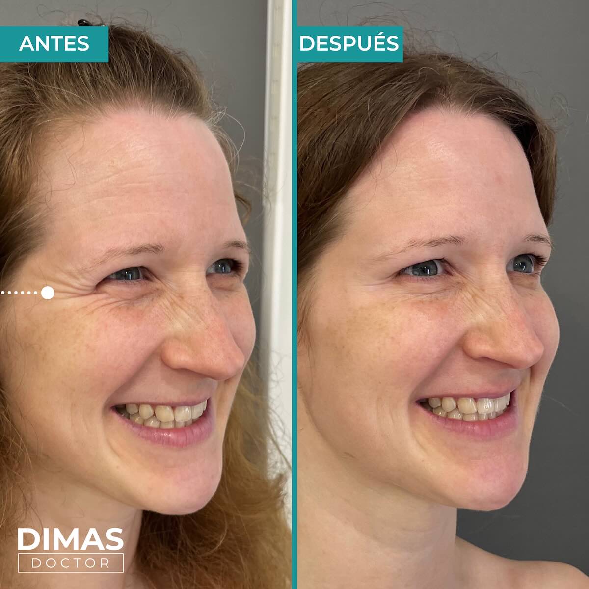 Resultados en patas de gallo tras tratamiento con toxina botulínica bótox