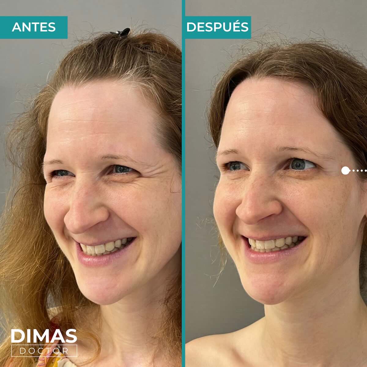 Resultados en patas de gallo tras tratamiento con toxina botulínica bótox