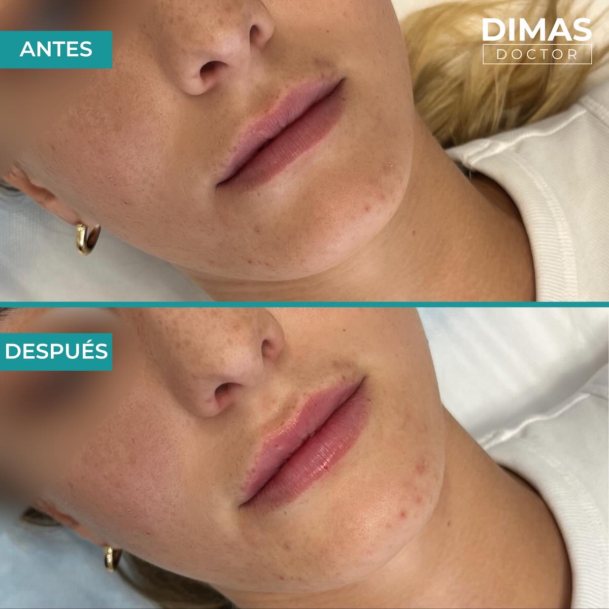 Relleno de labios con ácido hialurónico en mujeres