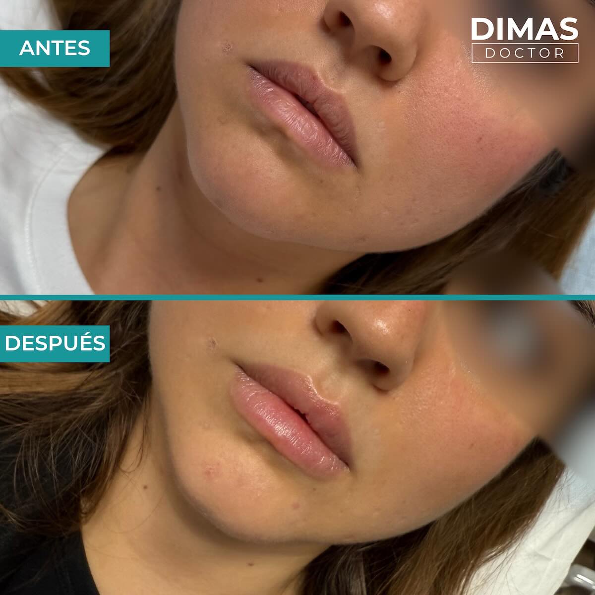 Relleno de labios con ácido hialurónico en mujeres