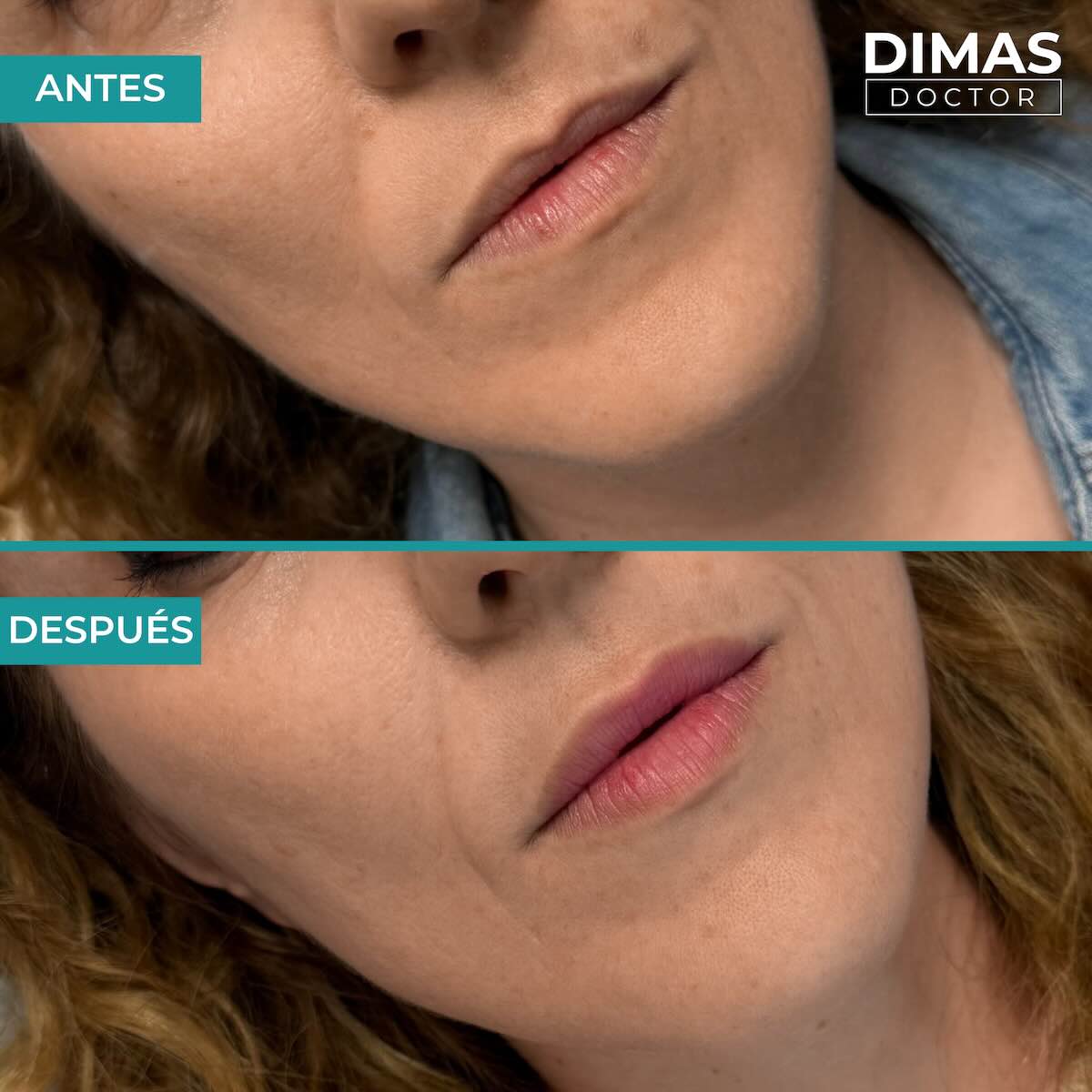 Relleno de labios con ácido hialurónico en mujeres