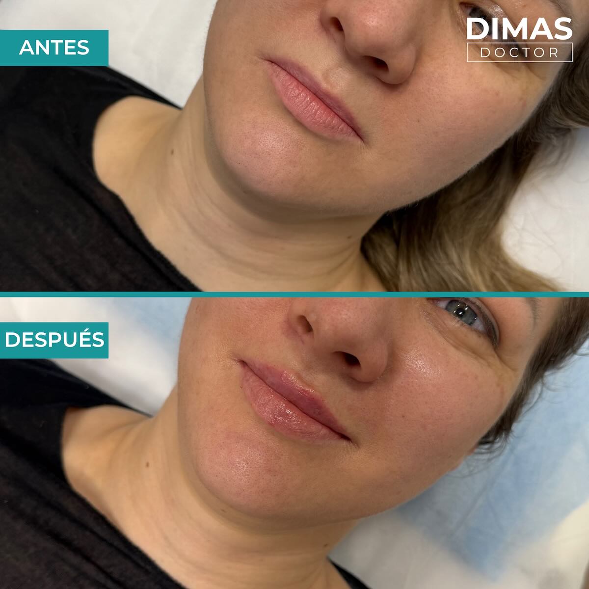 Relleno de labios con ácido hialurónico en mujeres