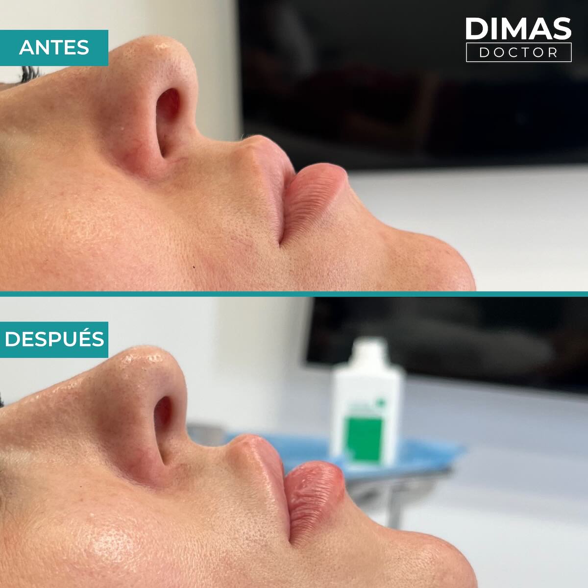 Relleno de labios con ácido hialurónico en mujeres