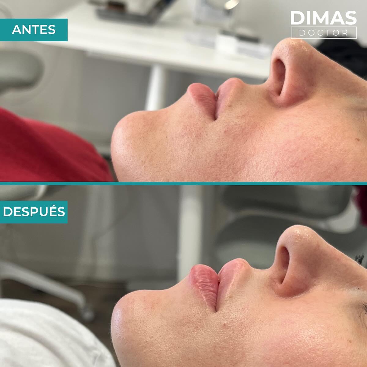 Relleno de labios con ácido hialurónico en mujeres