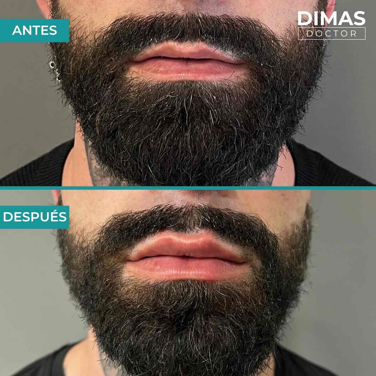 Relleno de labios con ácido hialurónico en hombres